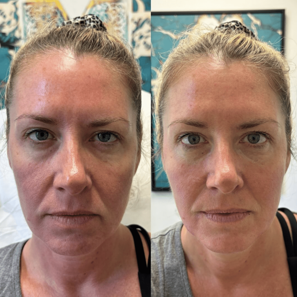 botox fort myers